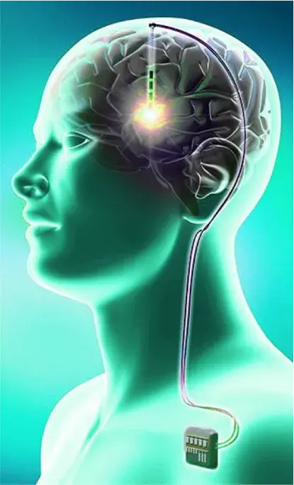 Deep brain stimulation